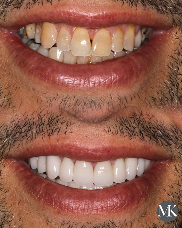 Porcelain Veneers in NYC Manhattan Upper East Side