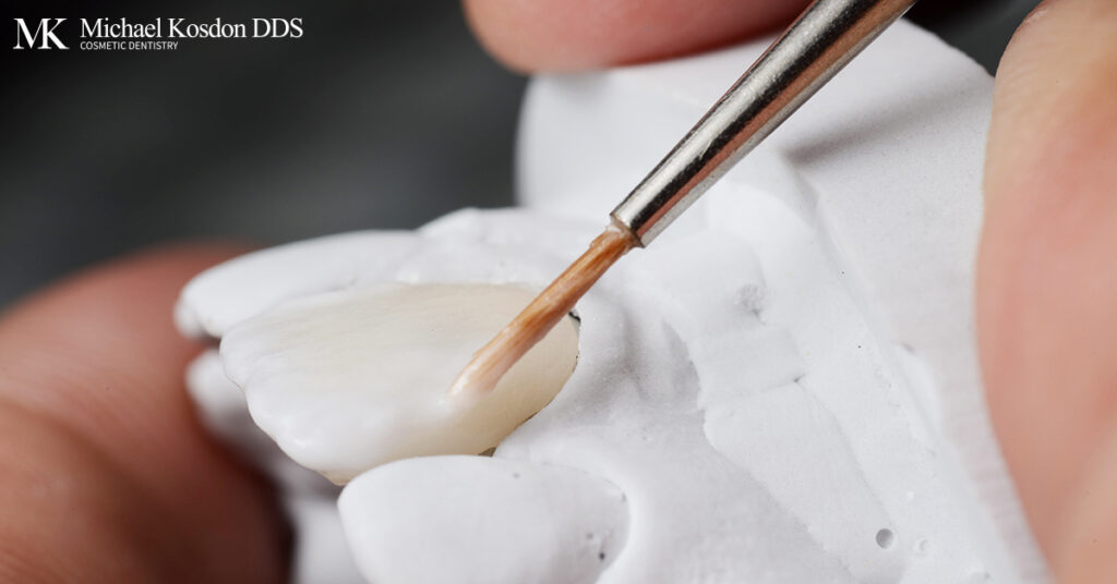 Porcelain Veneers Cost & Prices NYC Manhattan Upper East Side