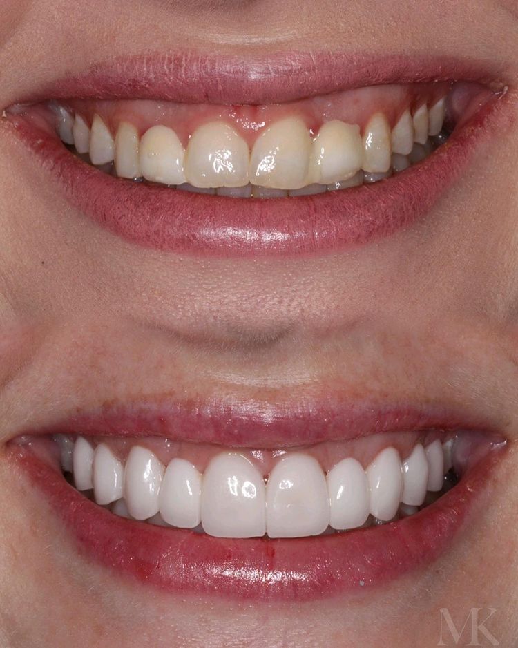 Porcelain Veneers in NYC Manhattan Upper East Side