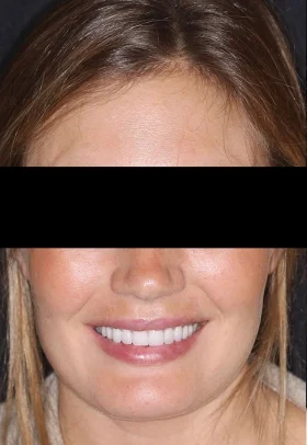 Porcelain Veneers After