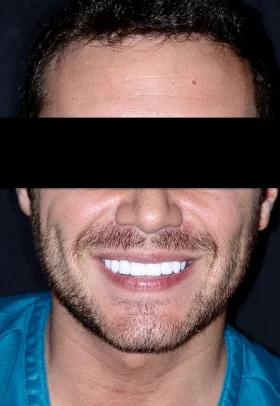 Porcelain Veneers After