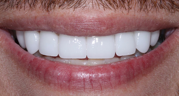 porcelain veneers after