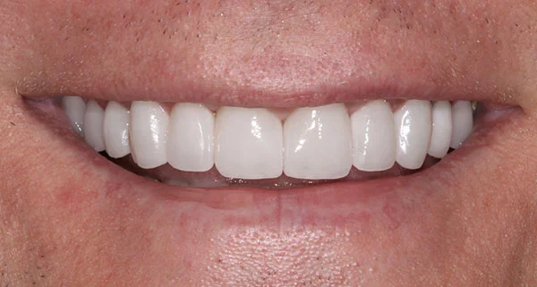 Porcelain Veneers