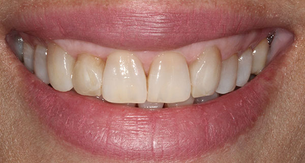 porcelain veneers before