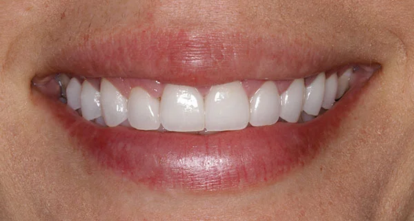 Porcelain Veneers