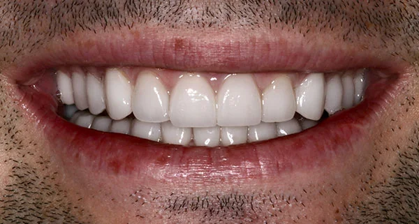 Porcelain Veneers