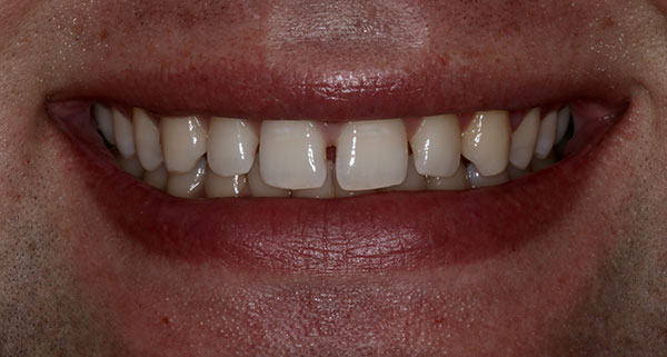 porcelain veneers before