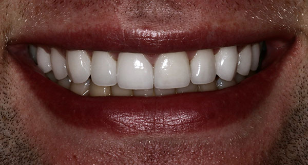 porcelain veneers after