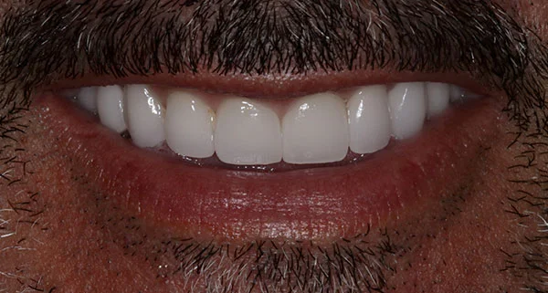 porcelain veneers after