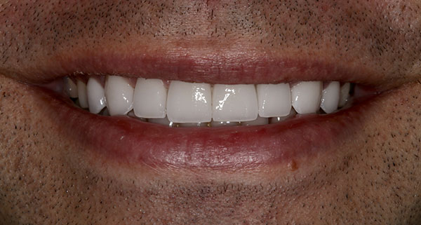 Porcelain Veneers