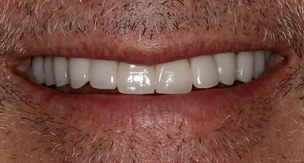 Porcelain Veneers