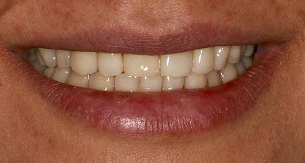 porcelain veneers before