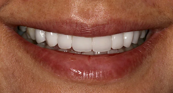 Porcelain Veneers