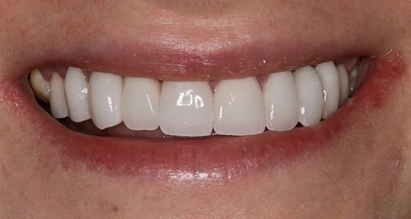 porcelain veneers after