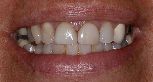 porcelain veneers before