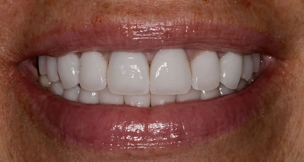 porcelain veneers after