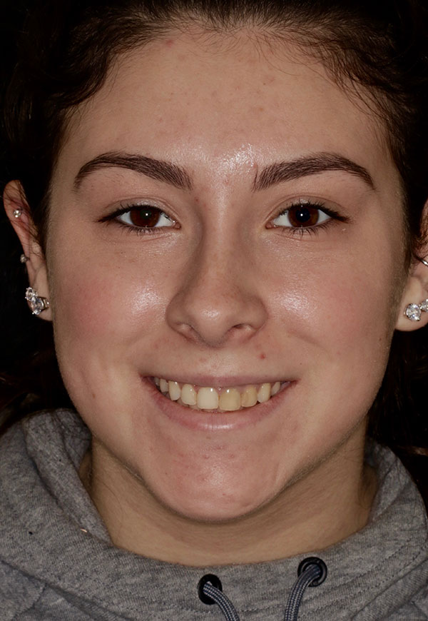 porcelain veneers before