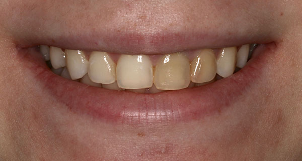 porcelain veneers before