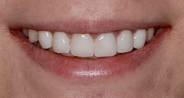 Porcelain Veneers