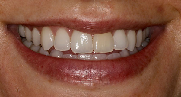 porcelain veneers before