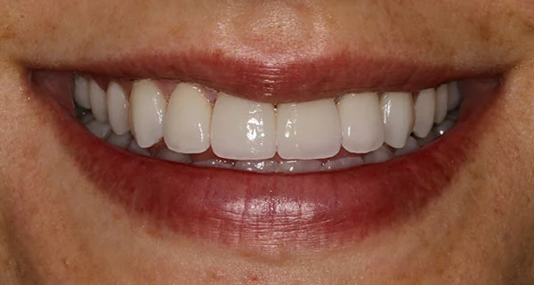 Porcelain Veneers