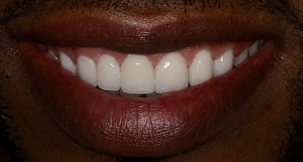 porcelain veneers after