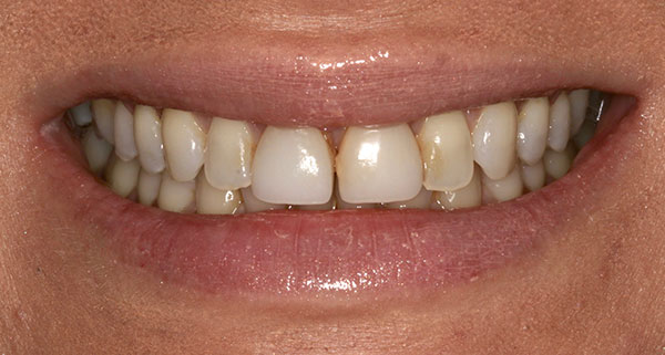 porcelain veneers before