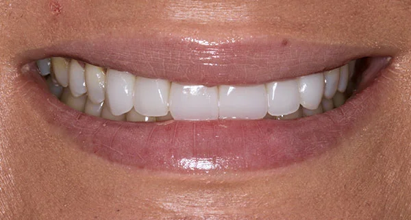 Porcelain Veneers