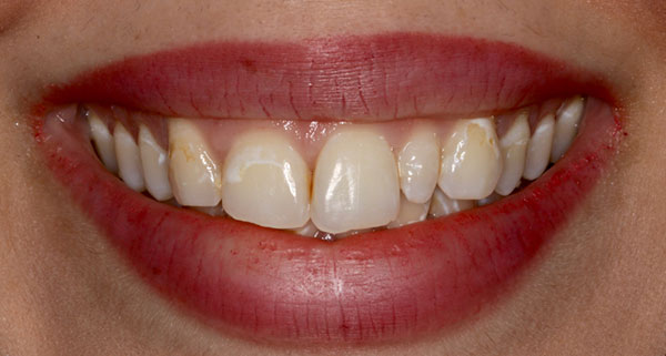 porcelain veneers before