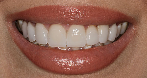 Porcelain Veneers