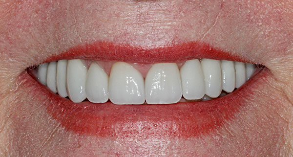 porcelain veneers after