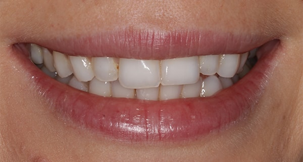 porcelain veneers before