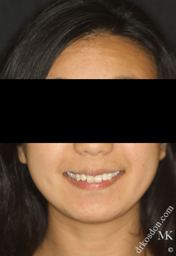 porcelain veneers before