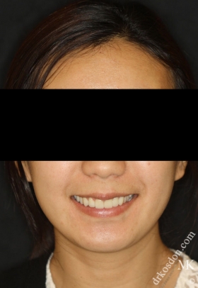 Porcelain Veneers After