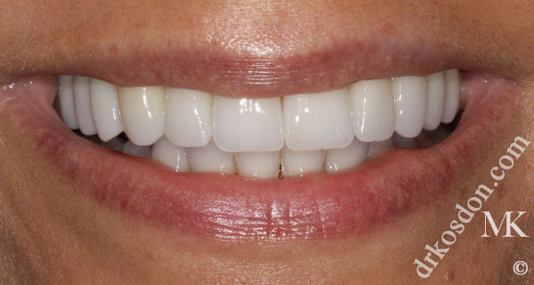 porcelain veneers after