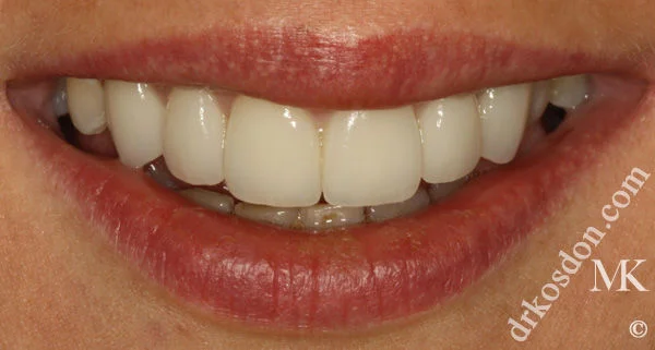 Porcelain Veneers