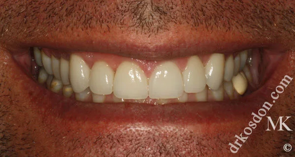 porcelain veneers after