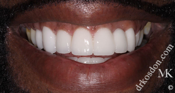 Porcelain Veneers