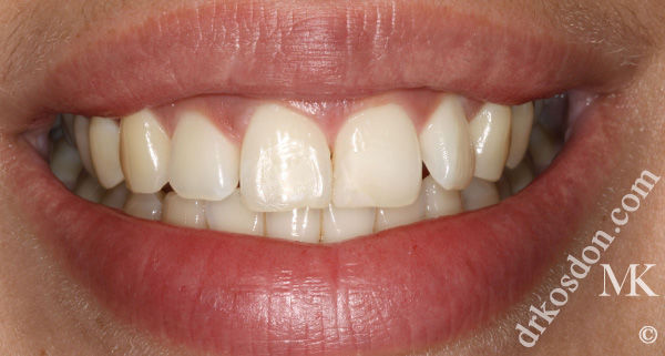 porcelain veneers before