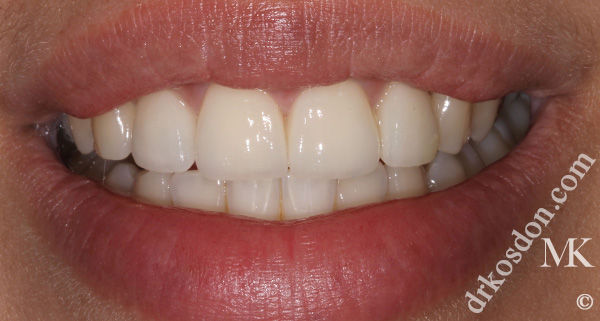 Porcelain Veneers