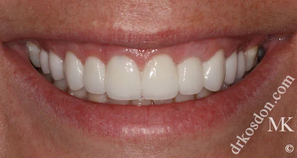 porcelain veneers after