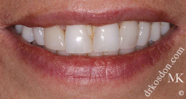 porcelain veneers before