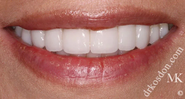 Porcelain Veneers