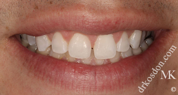 porcelain veneers before