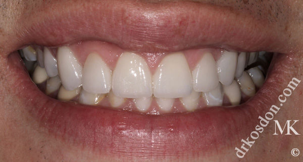 Porcelain Veneers