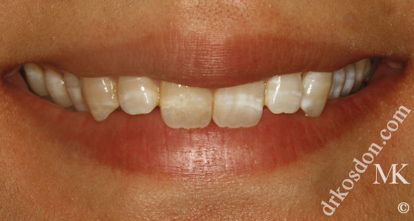 porcelain veneers before