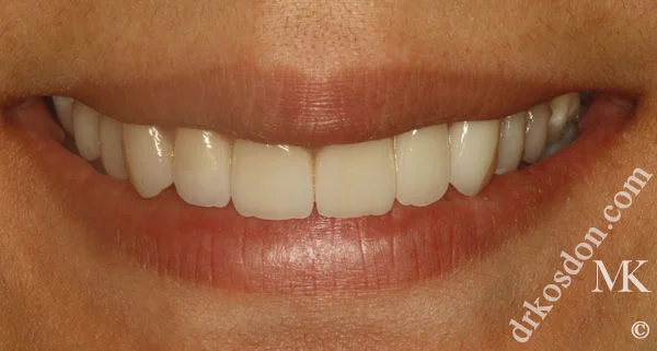 porcelain veneers after