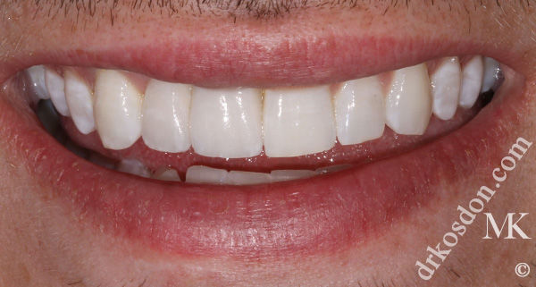 porcelain veneers after