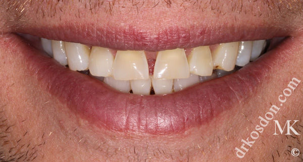 porcelain veneers before