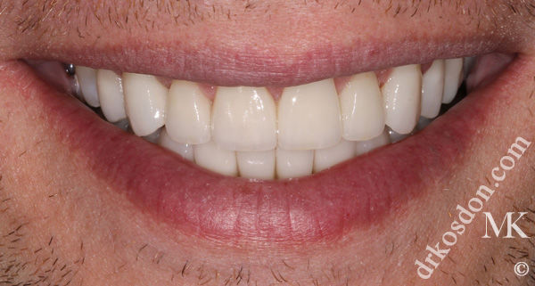 Porcelain Veneers